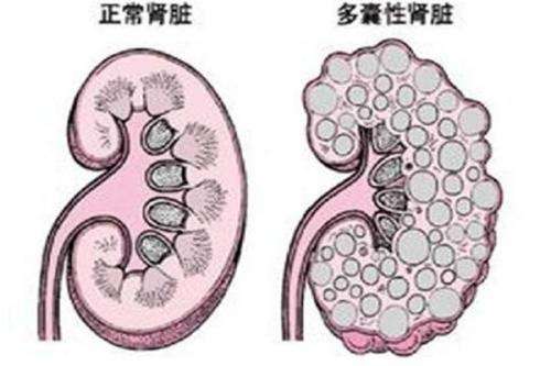 多囊肾选择泰国第三代试管婴儿可避免遗传宝宝