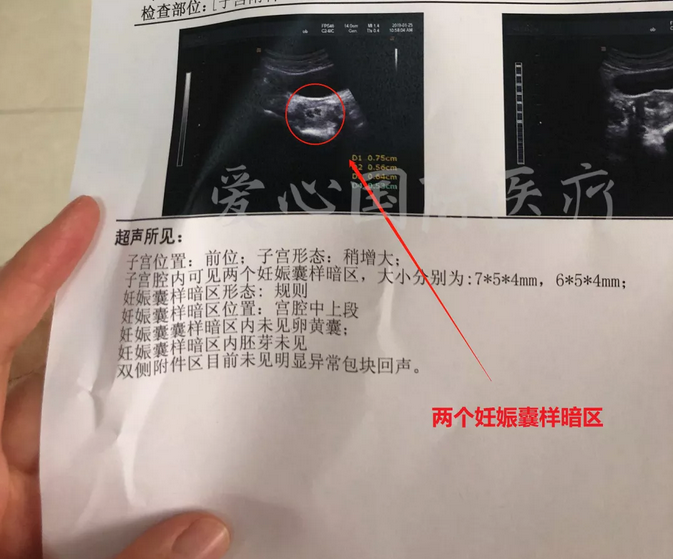 验孕成功