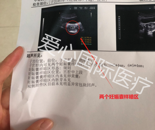 爱心国际成功案例